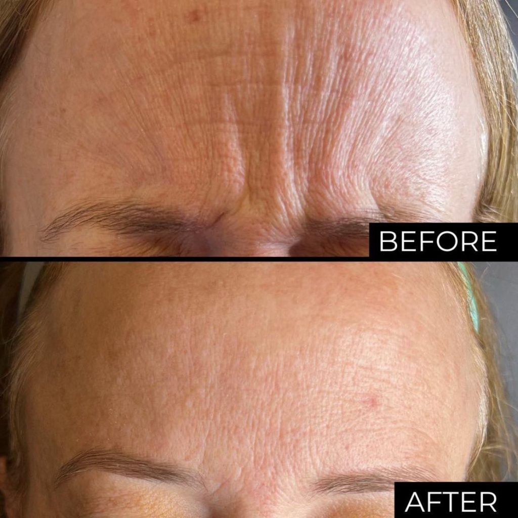 Botox before and after results showing smoothed forehead frown lines at Victoria Edward Spa in Longwood, FL
