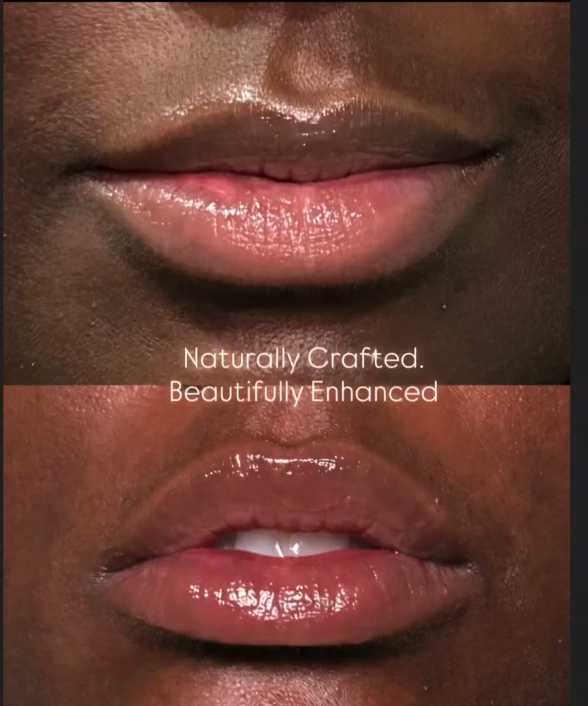Lip filler before and after results showing naturally enhanced fuller lips at Victoria Edward Spa in Longwood, FL