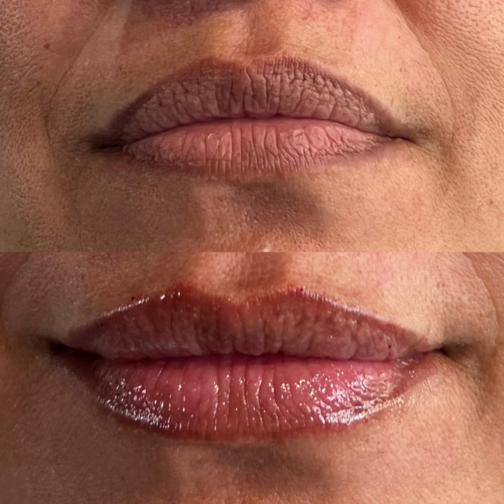 Dermal filler before and after lips, fuller natural-looking lips, Victoria Edward Spa Longwood FL