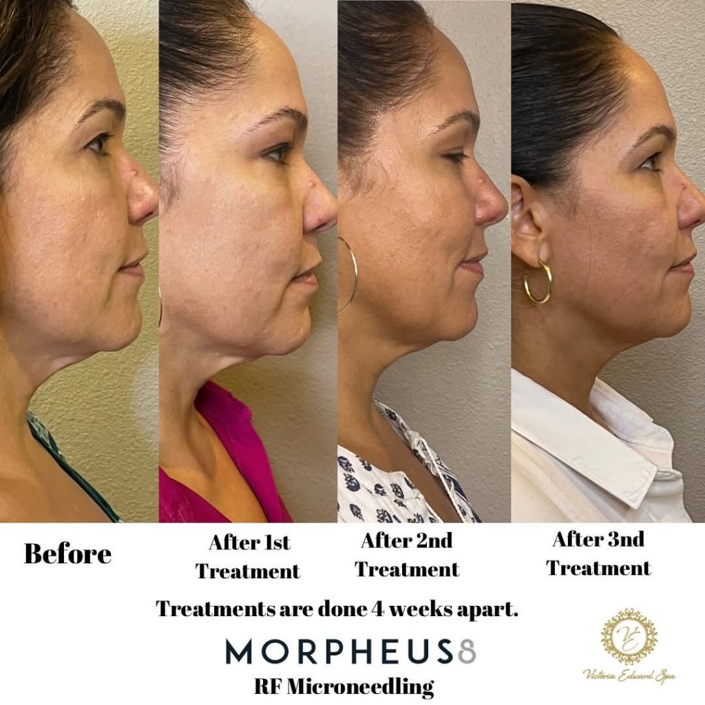 Morpheus8 RF microneedling before and after results after 1st, 2nd, and 3rd treatments, jawline and neck tightening, Victoria Edward Spa Longwood FL