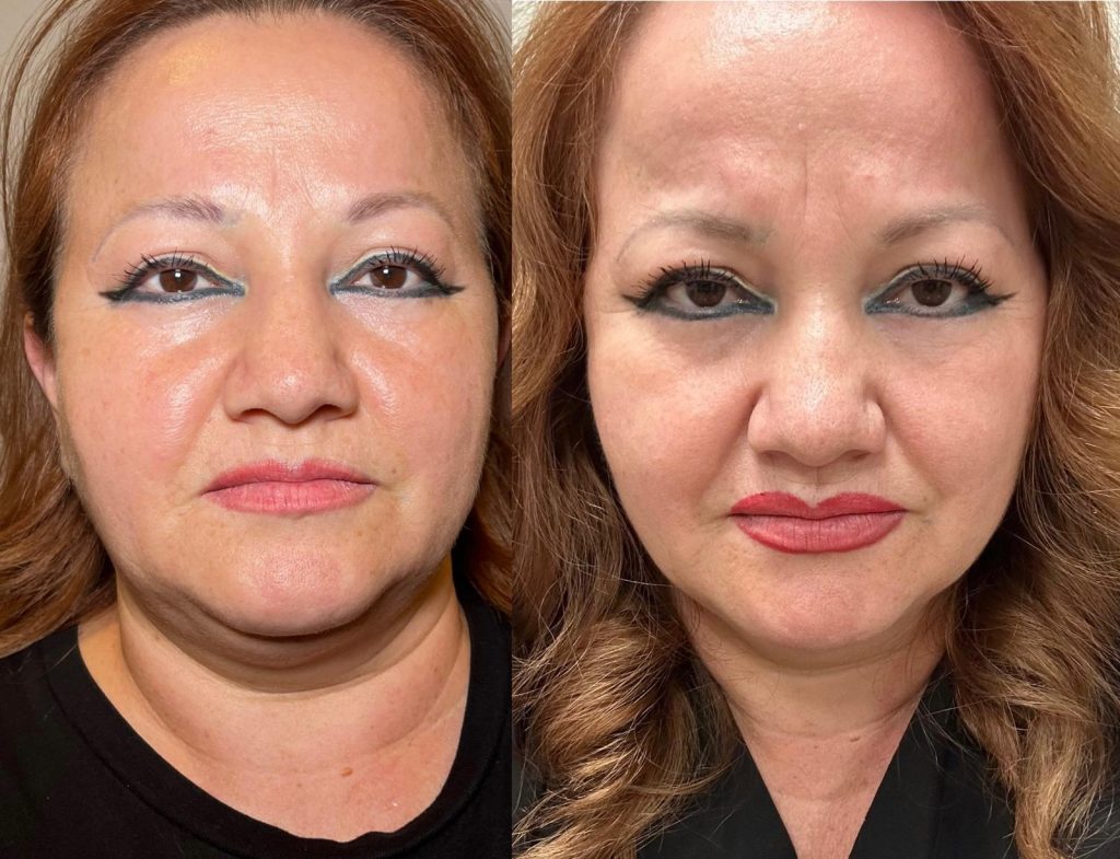 Morpheus8 patient before and after full face, reduced neck fat and defined jawline, Victoria Edward Spa Longwood FL