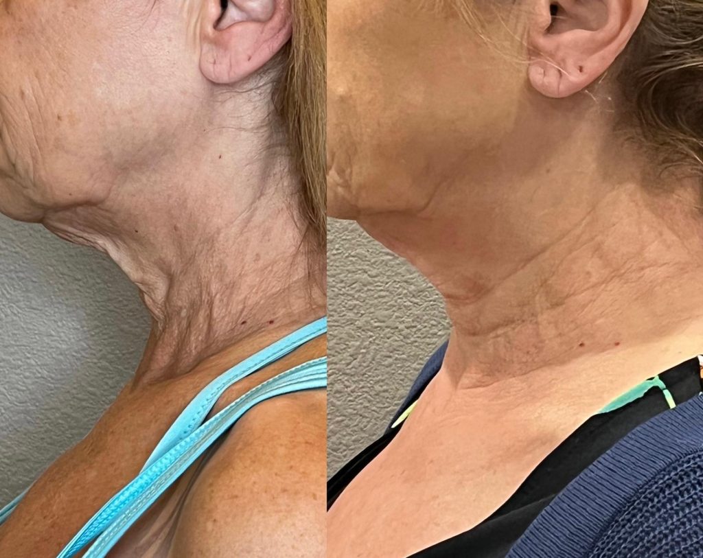 Morpheus8 before and after side neck profile, jawline definition and skin tightening, Victoria Edward Spa Longwood FL