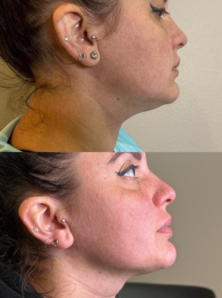 Morpheus8 before and after neck profile, tighter skin and reduced sagging, Victoria Edward Spa Longwood FL