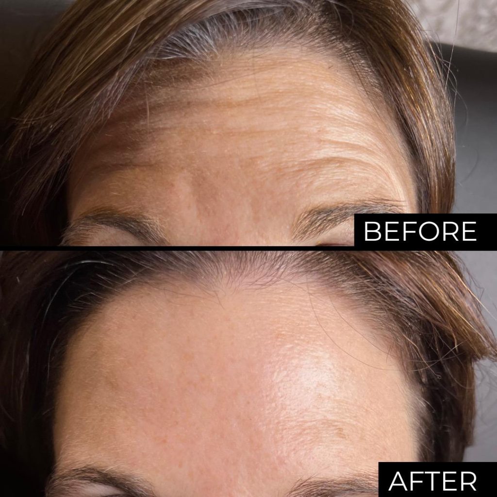 Botox before and after forehead lines, smoother skin, Victoria Edward Spa Longwood FL