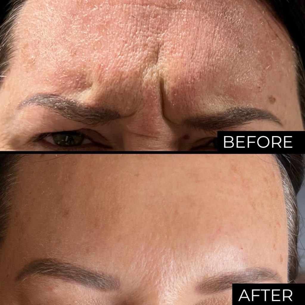 Daxxify before and after forehead wrinkles, refreshed skin, Victoria Edward Spa Longwood FL
