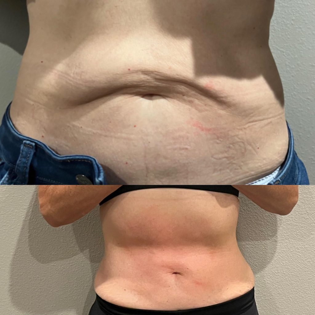 Weight loss before and after abdomen front view, GLP-1 program results, Victoria Edward Spa Longwood FL