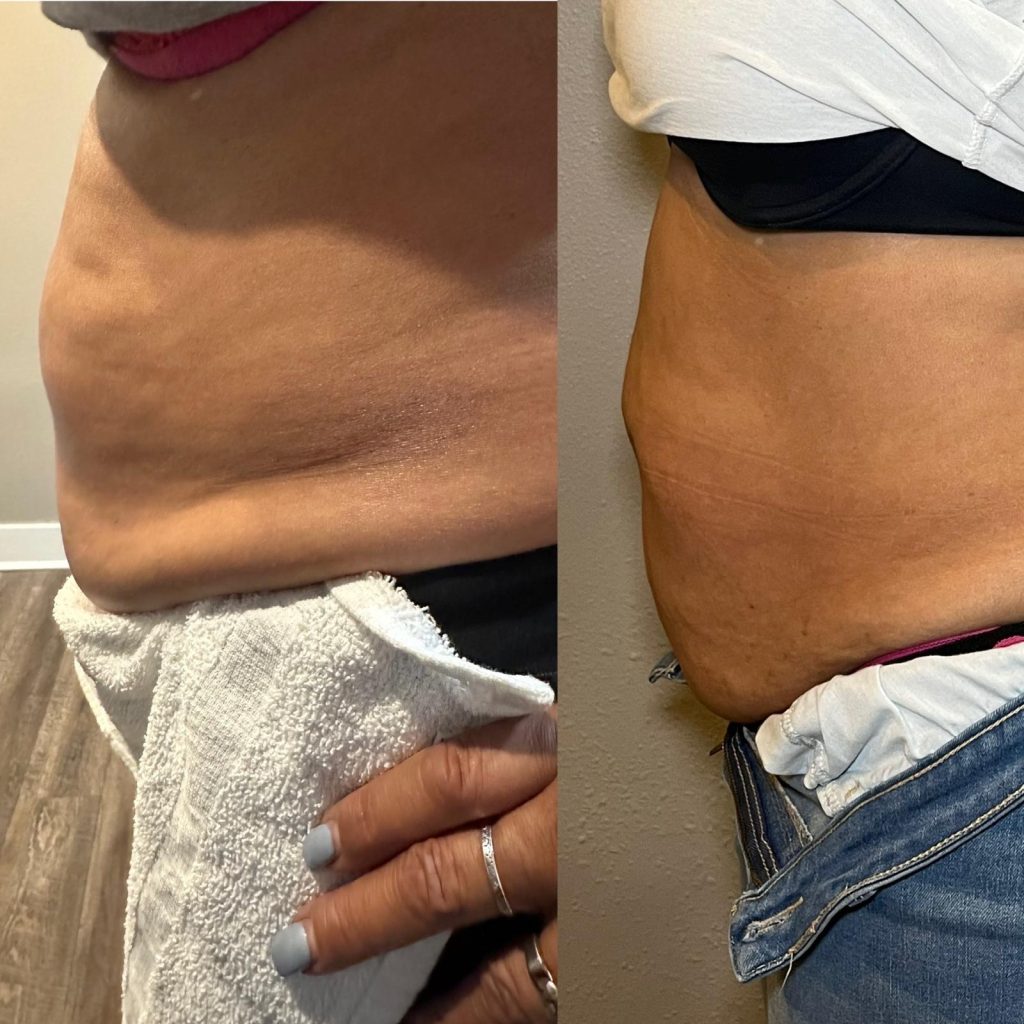 Weight loss before and after side profile, slimmer waistline, Victoria Edward Spa Longwood FL