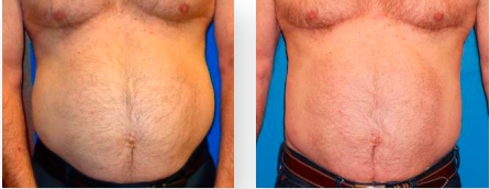 Weight loss before and after abdomen, semaglutide fat reduction, Victoria Edward Spa Longwood FL