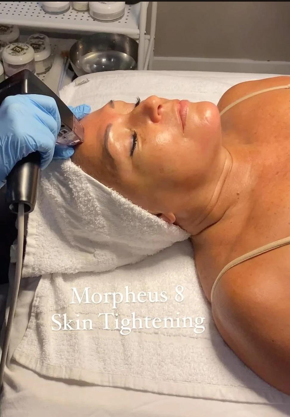 Morpheus8 skin tightening treatment at Victoria Edward Spa in Longwood, FL
