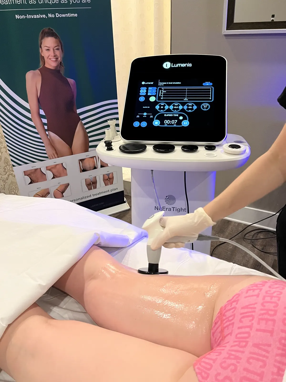 NuEra Tight in Longwood, FL: the Lumenis NuEra Tight device during a body treatment at Victoria Edward Spa